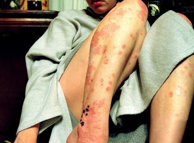 Le psoriasis, un facteur majeur de risque de dépression