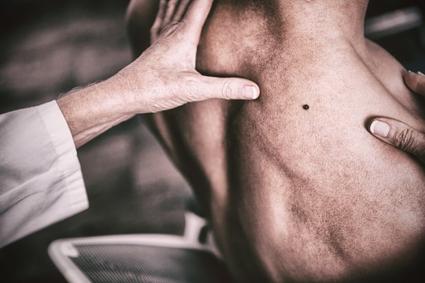 Laat bruine vlekjes geen blinde vlekken zijn