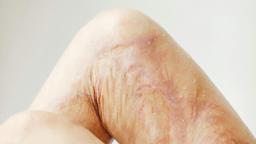 Crans-Montana : "La revalidation des victimes peut prendre des mois, voire des années."